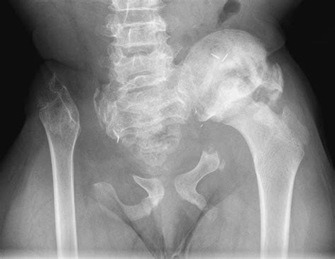 what is a hemipelvectomy.